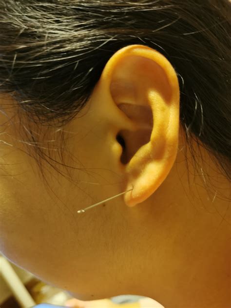 金黴素 耳洞